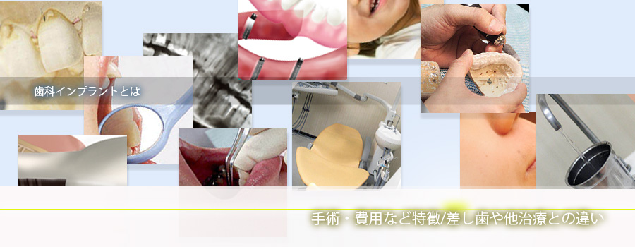 歯科インプラントとは – 手術・費用など特徴/差し歯や他治療との違い